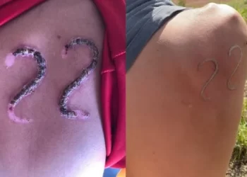 Jovem usa ferro em brasa para marcar 22 de Bolsonaro na pele