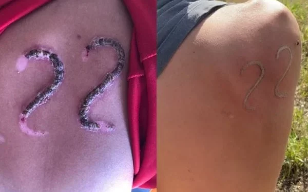 Jovem usa ferro em brasa para marcar 22 de Bolsonaro na pele