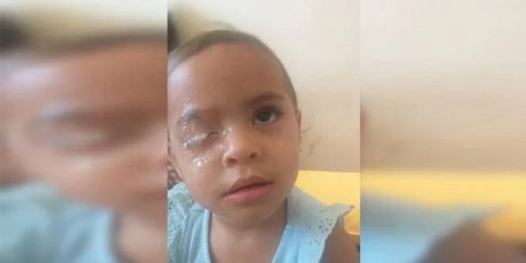 Menina de 2 anos vai parar no hospital após grudar olho com cola