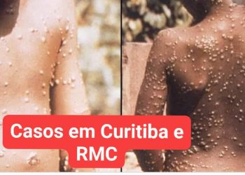 Cuidado! Varíola do macaco chegou em Curitiba