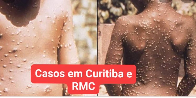 Cuidado! Varíola do macaco chegou em Curitiba