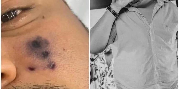 CANTOR DE FORRÓ MORRE APÓS SER PICADO POR ARANHA E ROSTO COMEÇAR A ESCURECER