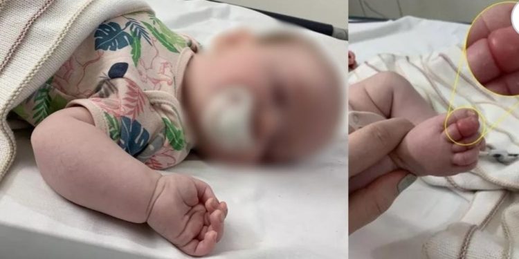 Bebê quase tem dedo do pé amputado após fio de cabelo da mãe ficar enroscado