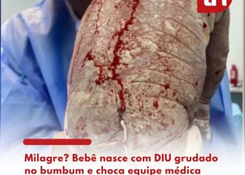 Bebê nas com DIU colado no corpo